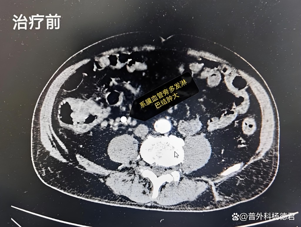 肠道CT影像