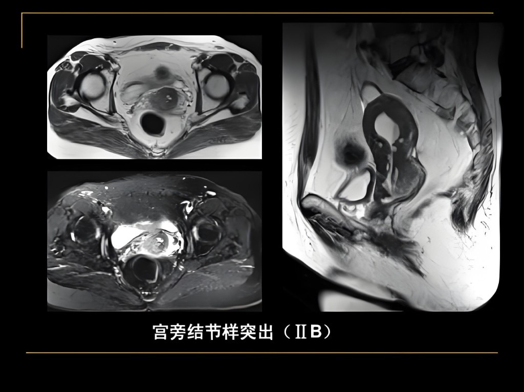 宫颈影像